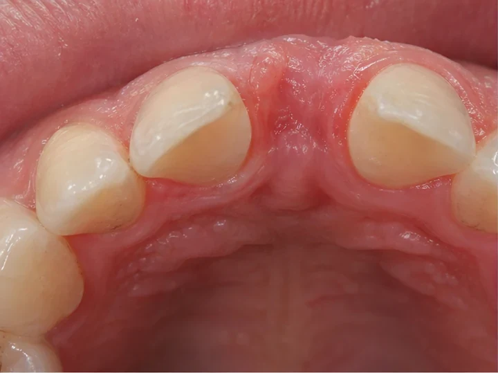 Pohled zezadu (od jazyka) — chybějící zub, sousední zuby s prirodzenou anatómiou na vnitřnej strane
