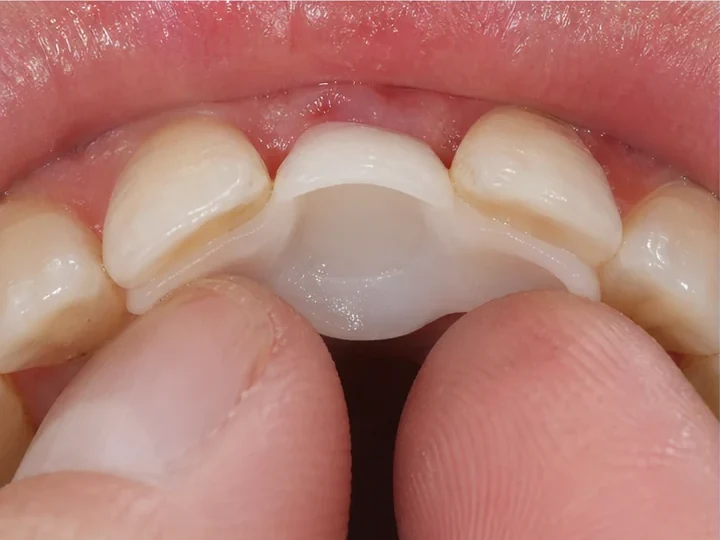 Vkladanie z vnitřnej strany — DentiFlex se pritláča okolo sousedních zubů a vytvára zámek zezadu