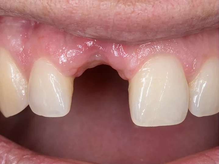 Přední pohled: chybějící přední zub, korunka v DentiFlexe, vloženie mezi okolní zuby a výsledek