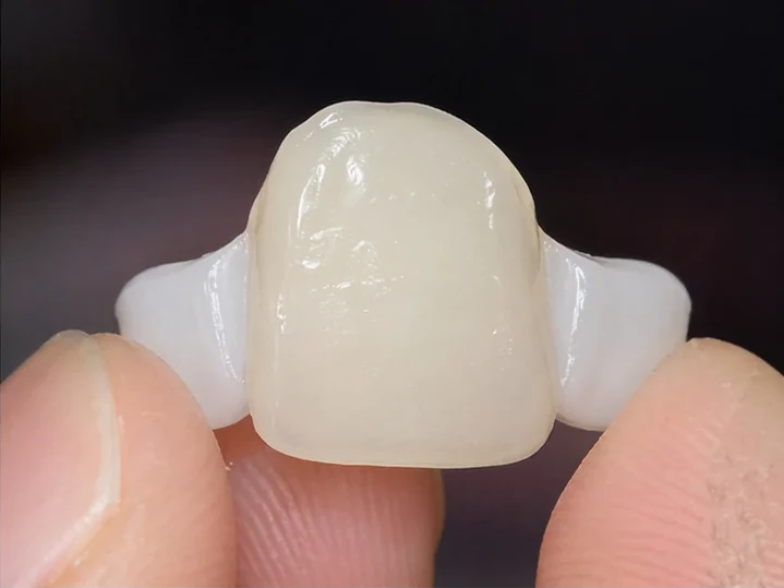 Přední pohled: chybějící přední zub, korunka v DentiFlexe, vloženie mezi okolní zuby a výsledek