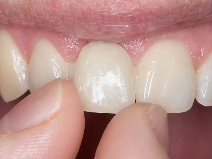 Přední pohled: chybějící přední zub, korunka v DentiFlexe, vloženie mezi okolní zuby a výsledek