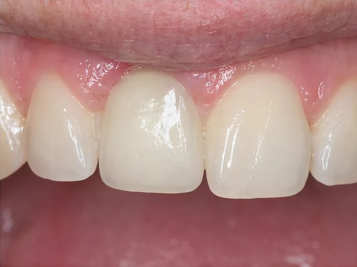 Přední pohled: chybějící přední zub, korunka v DentiFlexe, vloženie mezi okolní zuby a výsledek