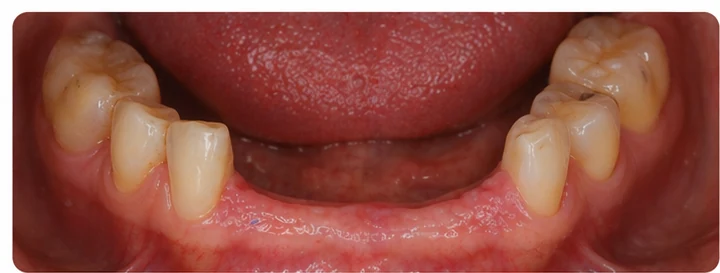 Vizuální postup pro dva premoláre a stoličku hore — princip vloženia Denticor můstku s novými zuby a jeho dotvarovania o okolní zuby