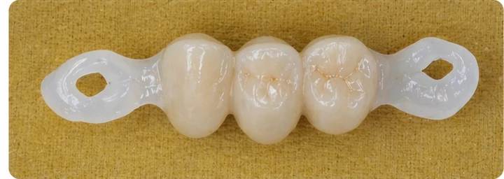 Vizuální postup pro dva premoláre a stoličku hore — princip vloženia Denticor můstku s novými zuby a jeho dotvarovania o okolní zuby