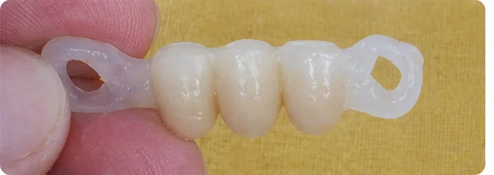 Vizuální postup pro dva premoláre a stoličku hore — princip vloženia Denticor můstku s novými zuby a jeho dotvarovania o okolní zuby