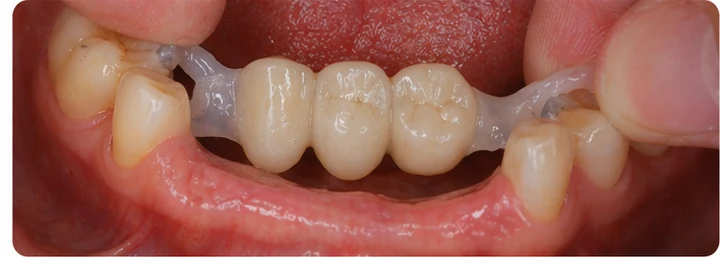 Vizuální postup pro dva premoláre a stoličku hore — princip vloženia Denticor můstku s novými zuby a jeho dotvarovania o okolní zuby