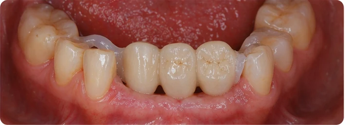 Vizuální postup pro dva premoláre a stoličku hore — princip vloženia Denticor můstku s novými zuby a jeho dotvarovania o okolní zuby