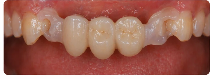 Vizuální postup pro dva premoláre a stoličku hore — princip vloženia Denticor můstku s novými zuby a jeho dotvarovania o okolní zuby
