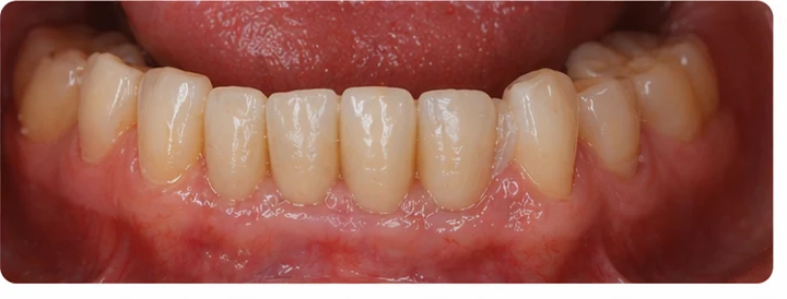 Vizuální postup pro dva premoláre a stoličku hore — princip vloženia Denticor můstku s novými zuby a jeho dotvarovania o okolní zuby