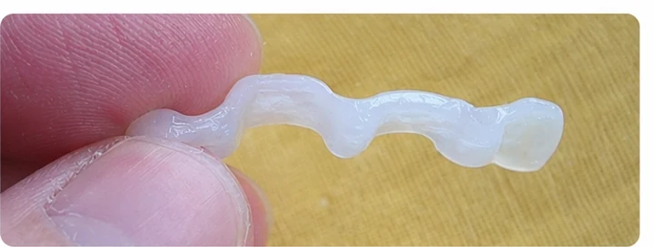 Vizuální postup pro dva sousední horní přední zuby — princip vloženia Denticor můstku s novými zuby a jeho dotvarovania o okolní zuby