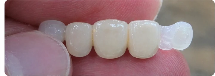 Vizuální postup pro dva sousední horní přední zuby — princip vloženia Denticor můstku s novými zuby a jeho dotvarovania o okolní zuby