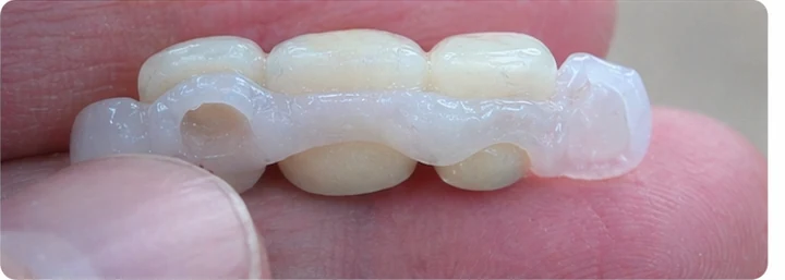 Vizuální postup pro dva sousední horní přední zuby — princip vloženia Denticor můstku s novými zuby a jeho dotvarovania o okolní zuby