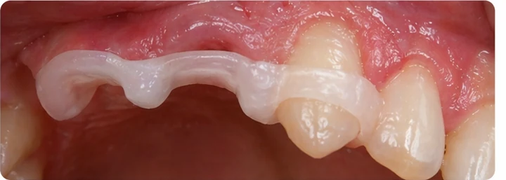 Vizuální postup pro dva sousední horní přední zuby — princip vloženia Denticor můstku s novými zuby a jeho dotvarovania o okolní zuby
