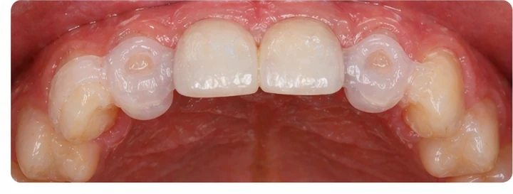 Vizuální postup pro dva sousední horní přední zuby — princip vloženia Denticor můstku s novými zuby a jeho dotvarovania o okolní zuby