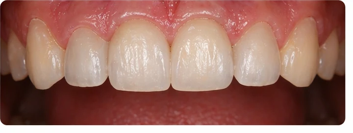 Vizuální postup pro dva sousední horní přední zuby — princip vloženia Denticor můstku s novými zuby a jeho dotvarovania o okolní zuby