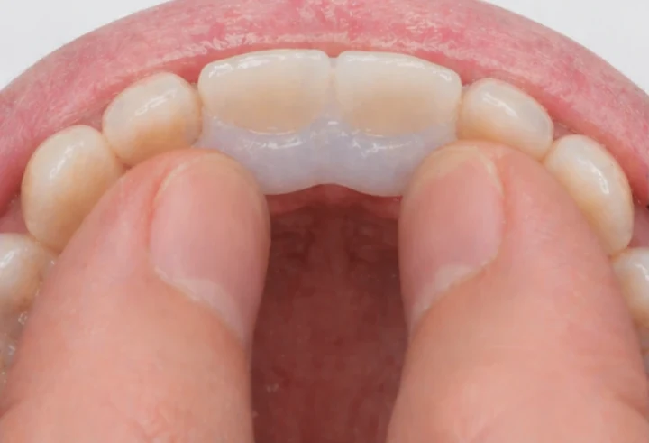 Denticor pro horní dva střední rezáky — pohled zezadu od podnebia: tvar můstku a dosadnuty za novými zuby