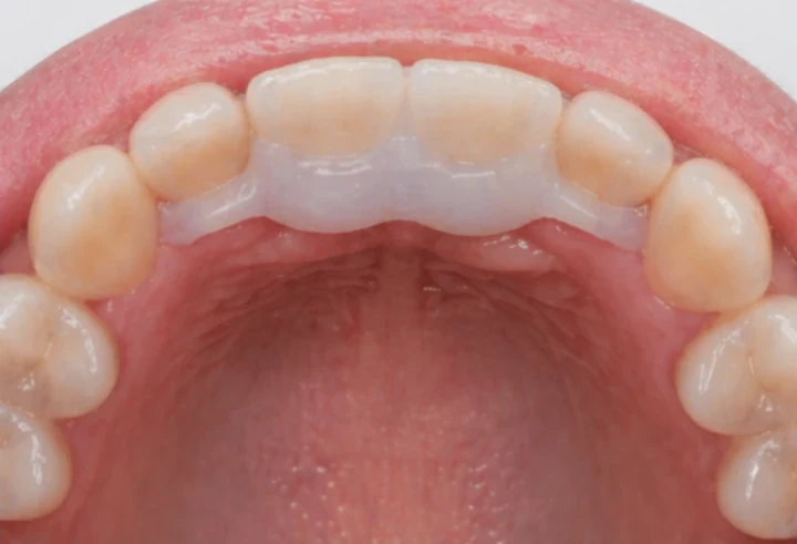 Denticor pro horní dva střední rezáky — pohled zezadu od podnebia: tvar můstku a dosadnuty za novými zuby