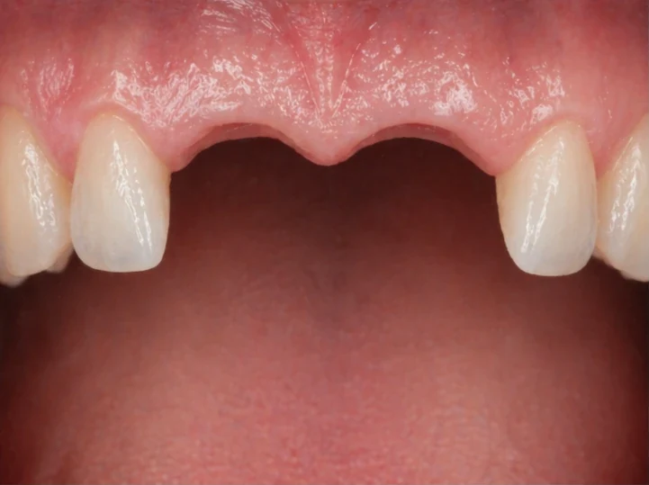 Denticor pro horní dva střední rezáky — pohled zepředu: mezera, připravená náhrada, vloženie a výsledek