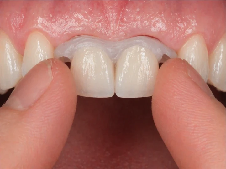 Denticor pro horní dva střední rezáky — pohled zepředu: mezera, připravená náhrada, vloženie a výsledek