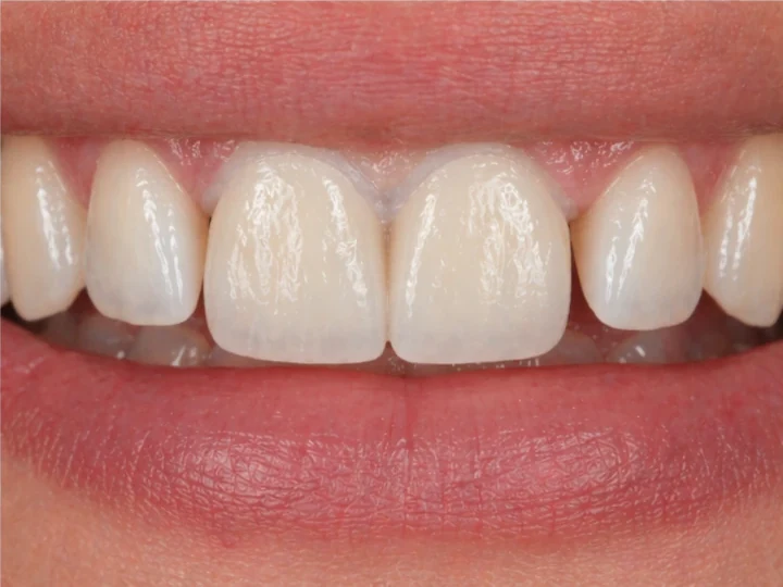 Denticor pro horní dva střední rezáky — pohled zepředu: mezera, připravená náhrada, vloženie a výsledek