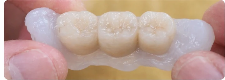 Vizuální návod — chybějící tři zadní horní zuby