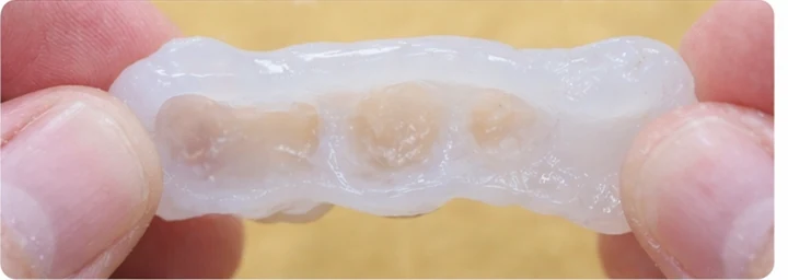 Vizuální návod — chybějící tři zadní horní zuby