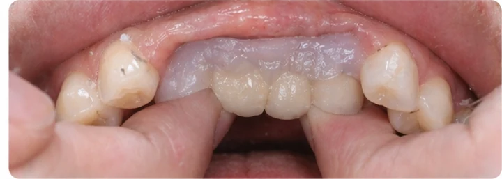 Vizuální návod — chybějící tři zadní horní zuby