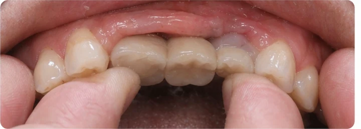 Vizuální návod — chybějící tři zadní horní zuby