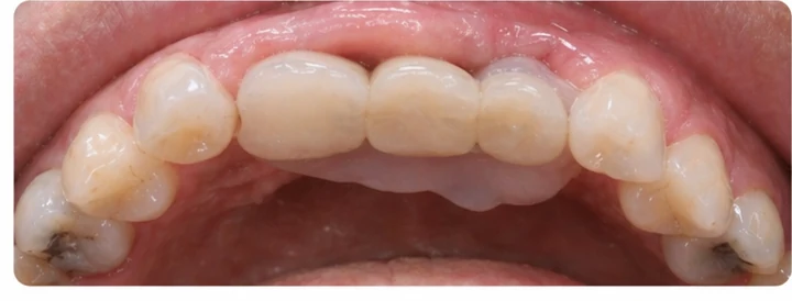 Vizuální návod — chybějící tři zadní horní zuby