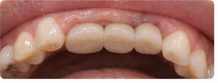 Vizuální návod — chybějící tři zadní horní zuby