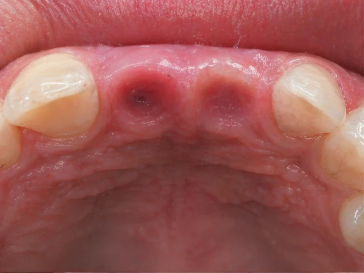 Denticor náhrada pro horní boční rezák a oční zub — pohled zezadu od podnebia, jako můstek obopína okolní zuby