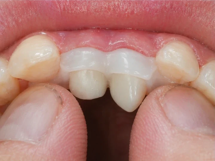 Denticor náhrada pro horní boční rezák a oční zub — pohled zezadu od podnebia, jako můstek obopína okolní zuby