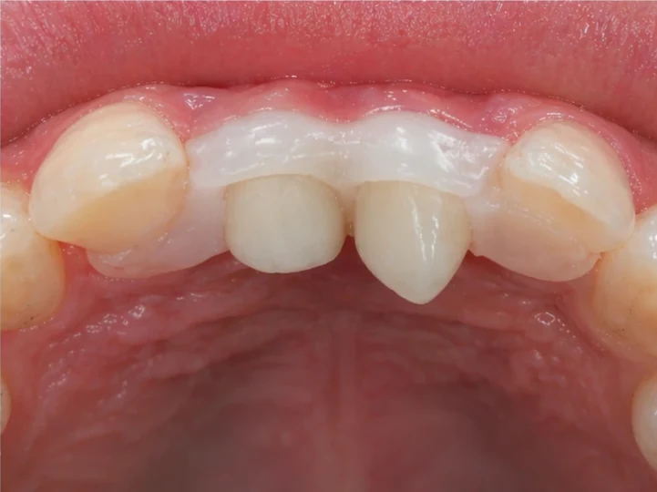 Denticor náhrada pro horní boční rezák a oční zub — pohled zezadu od podnebia, jako můstek obopína okolní zuby