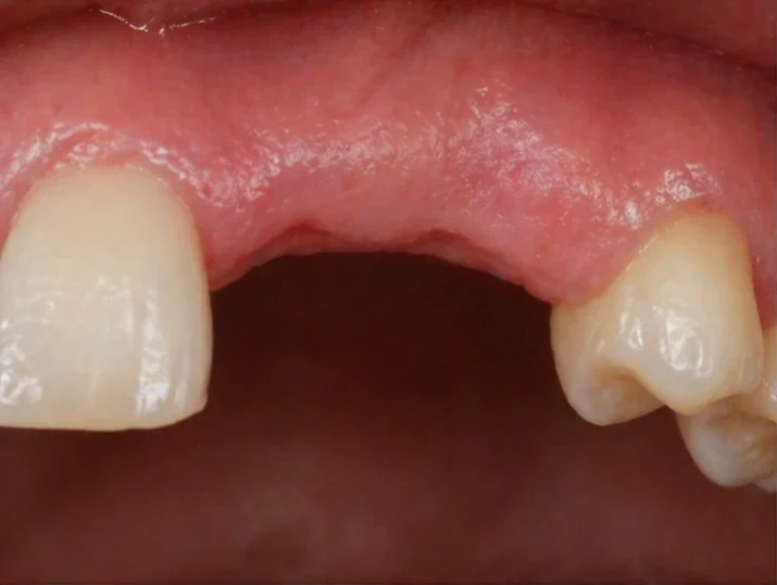 Vizuální návod — chybějící dva dolní premoláre