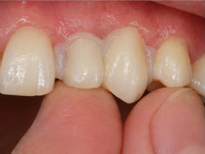 Vizuální návod — chybějící dolní rezák a oční zub