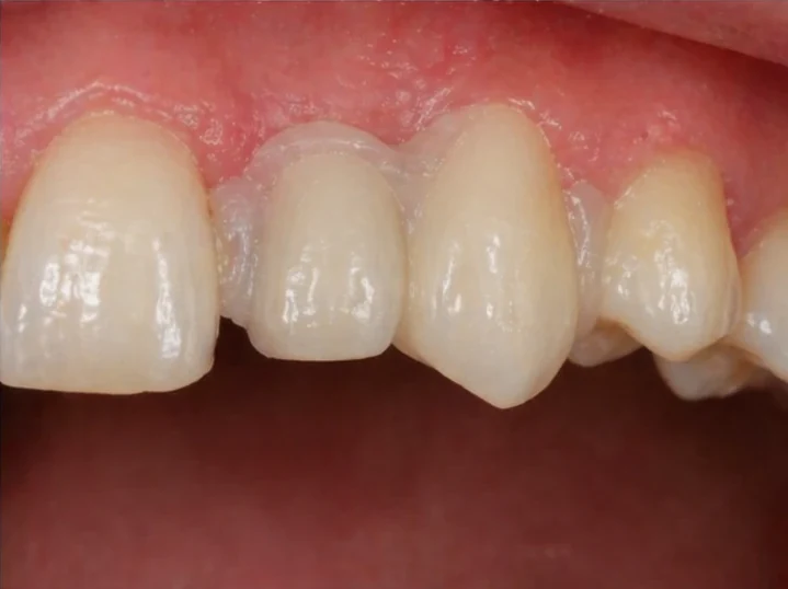 Denticor náhrada pro horní boční rezák a oční zub — pohled zepředu, vloženie můstku a výsledek