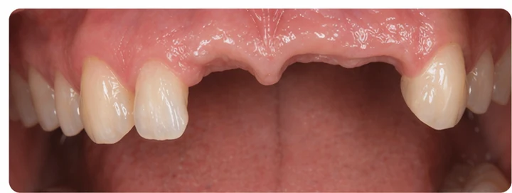 Vizuální postup pro oční zub a dva premoláre hore — princip vloženia Denticor můstku s novými zuby a jeho dotvarovania o okolní zuby