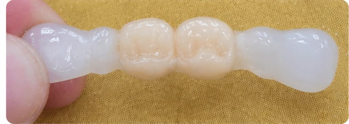 Vizuální postup pro oční zub a dva premoláre hore — princip vloženia Denticor můstku s novými zuby a jeho dotvarovania o okolní zuby