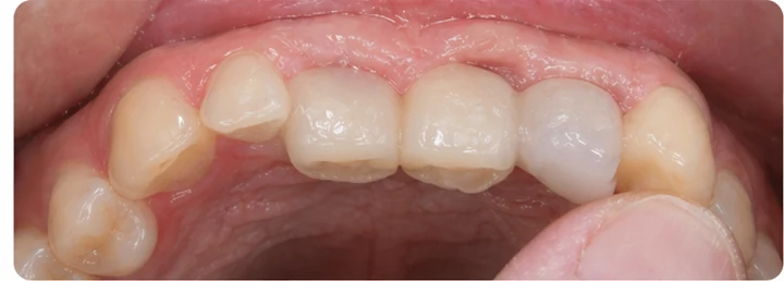 Vizuální postup pro oční zub a dva premoláre hore — princip vloženia Denticor můstku s novými zuby a jeho dotvarovania o okolní zuby