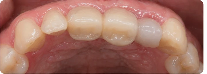 Vizuální postup pro oční zub a dva premoláre hore — princip vloženia Denticor můstku s novými zuby a jeho dotvarovania o okolní zuby