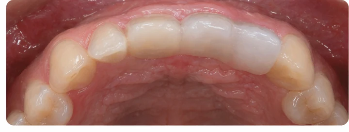 Vizuální postup pro oční zub a dva premoláre hore — princip vloženia Denticor můstku s novými zuby a jeho dotvarovania o okolní zuby