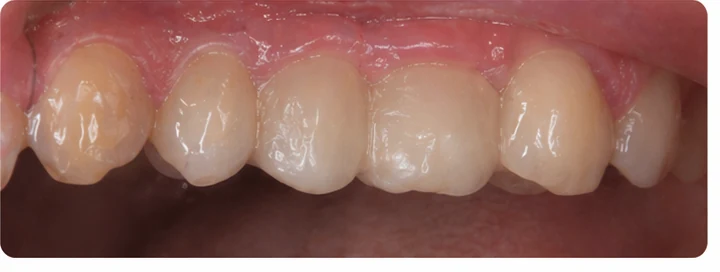 Vizuální postup pro oční zub a dva premoláre hore — princip vloženia Denticor můstku s novými zuby a jeho dotvarovania o okolní zuby