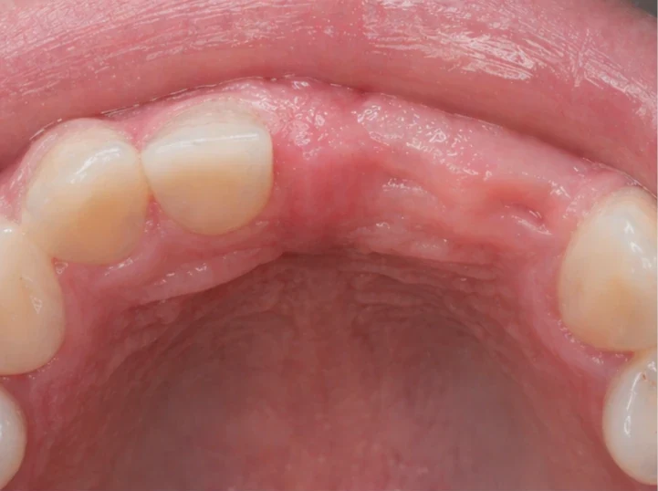 Denticor pro horní stredný a boční rezák — pohled zezadu od podnebia: tvar můstku a dosadnuty za novými zuby