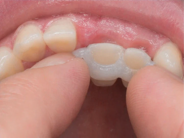 Denticor pro horní stredný a boční rezák — pohled zezadu od podnebia: tvar můstku a dosadnuty za novými zuby