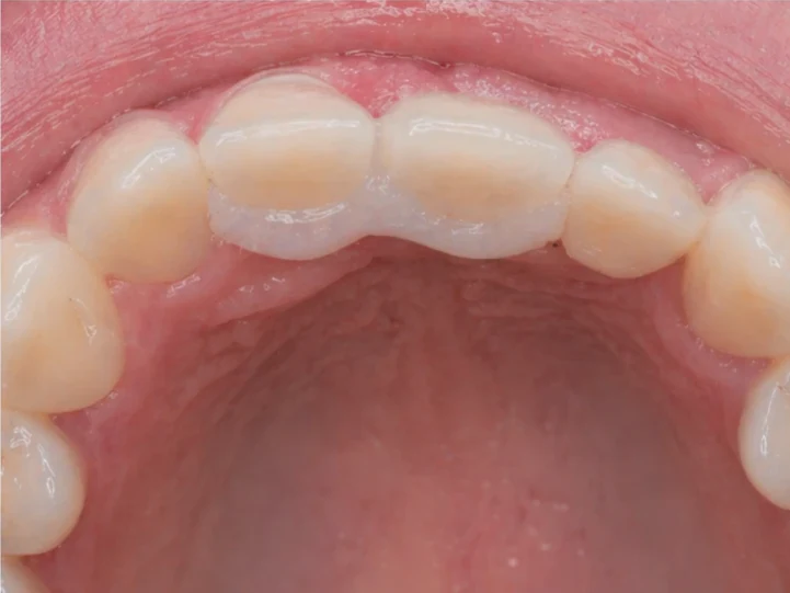 Denticor pro horní stredný a boční rezák — pohled zezadu od podnebia: tvar můstku a dosadnuty za novými zuby