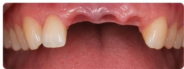 Vizuální postup pro tři sousední zuby v horním oblúku — princip vloženia Denticor můstku s novými zuby a jeho dotvarovania o okolní zuby