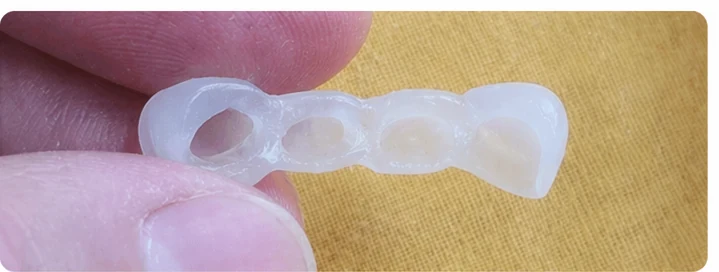 Vizuální postup pro tři sousední zuby v horním oblúku — princip vloženia Denticor můstku s novými zuby a jeho dotvarovania o okolní zuby