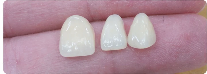 Vizuální postup pro tři sousední zuby v horním oblúku — princip vloženia Denticor můstku s novými zuby a jeho dotvarovania o okolní zuby