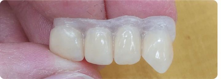 Vizuální postup pro tři sousední zuby v horním oblúku — princip vloženia Denticor můstku s novými zuby a jeho dotvarovania o okolní zuby