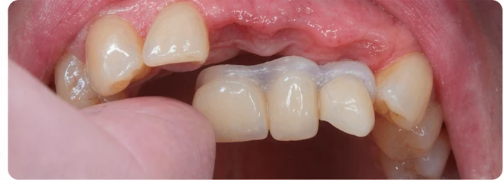 Vizuální postup pro tři sousední zuby v horním oblúku — princip vloženia Denticor můstku s novými zuby a jeho dotvarovania o okolní zuby
